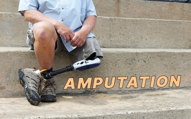 Amputation