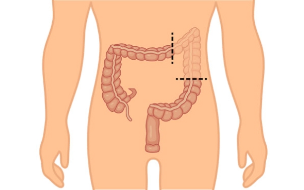 Colectomy