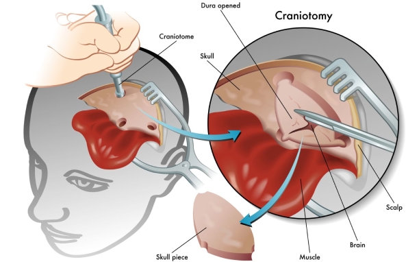 Craniotomy