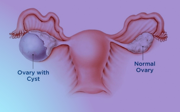 Cystectomy