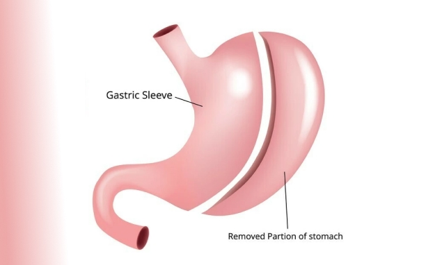 Gastrectomy