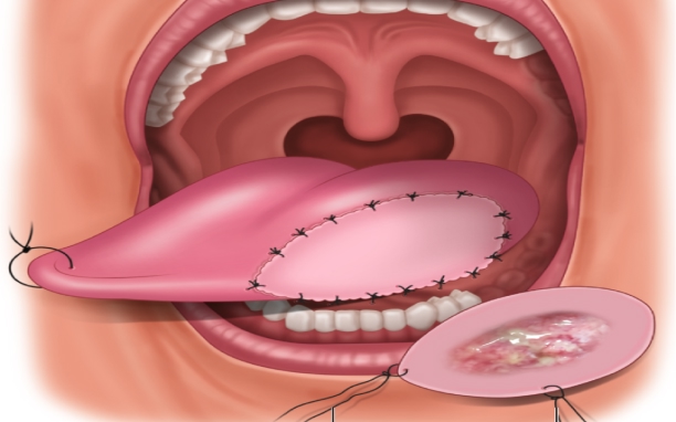 Glossectomy