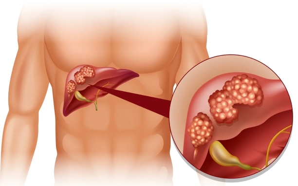 Liver Resection/Hepatectomy