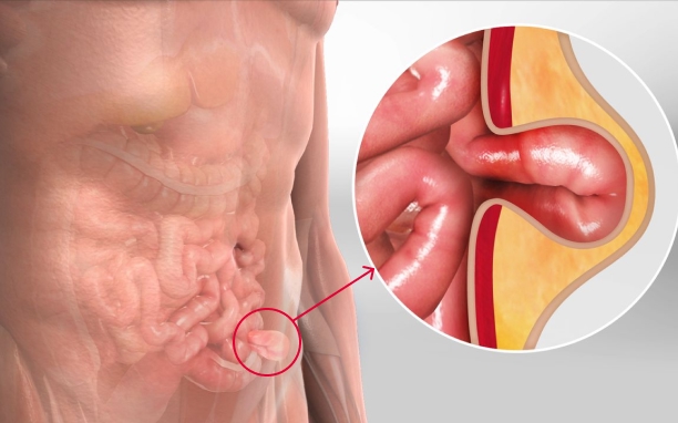 Laparoscopic Hernia Repair