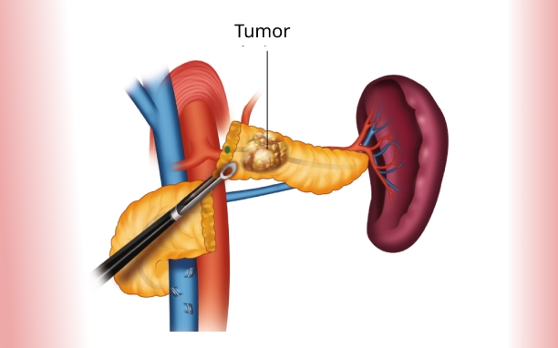 Pancreatectomy