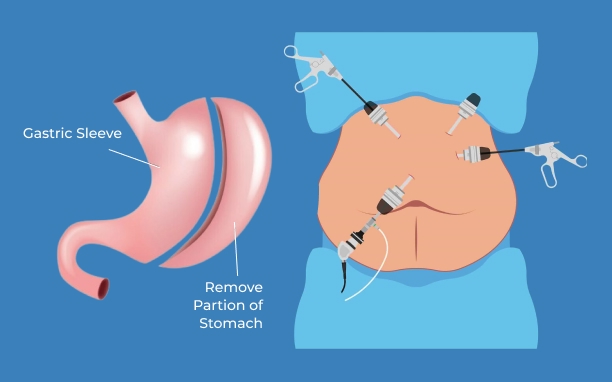 Laparoscopic Sleeve Gastrectomy