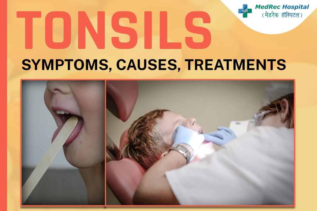 What are tonsil stones — and how do you know if you have them?