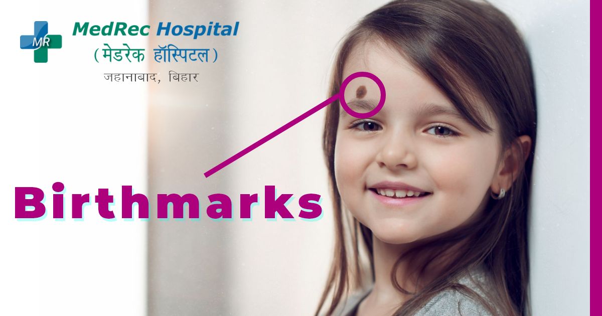birthmark types causes