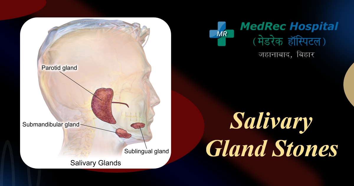 salivary gland stones
