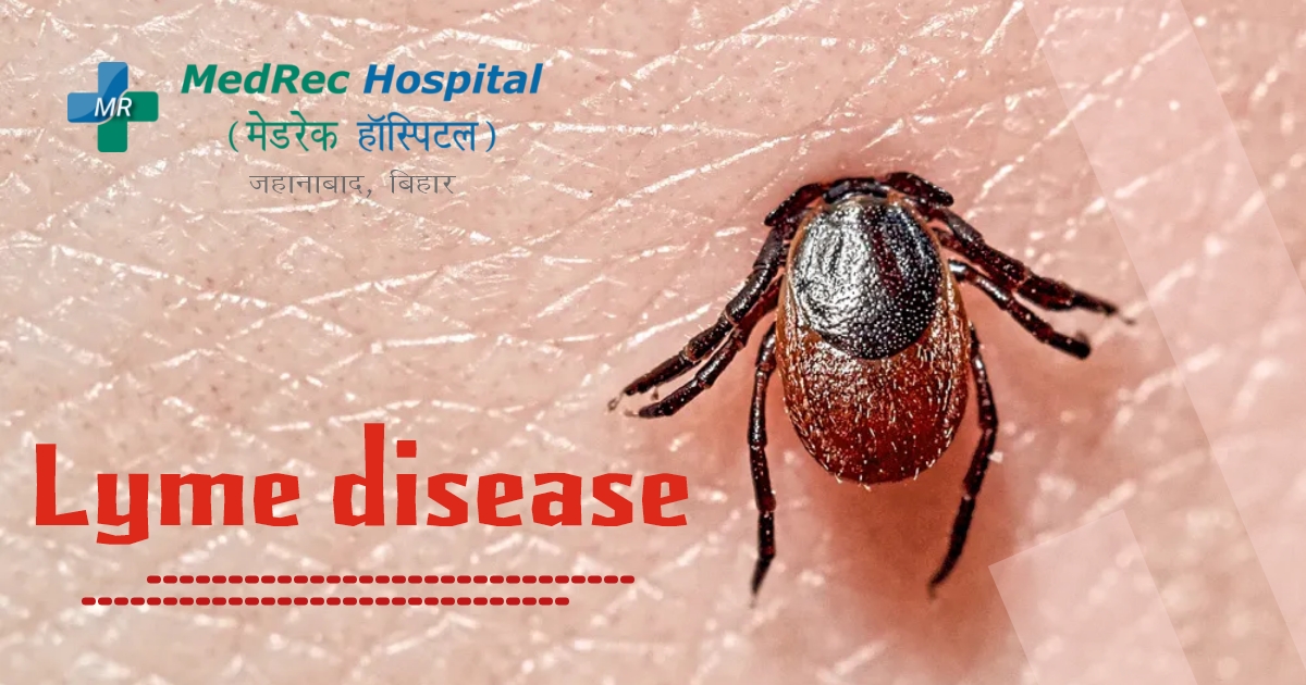 lyme disease