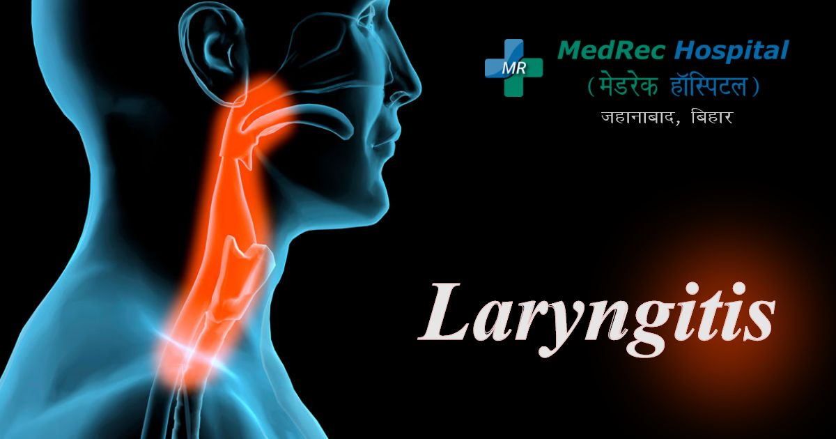 laryngitis