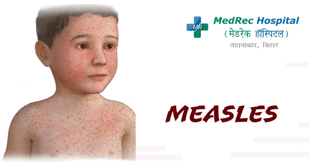 measles
