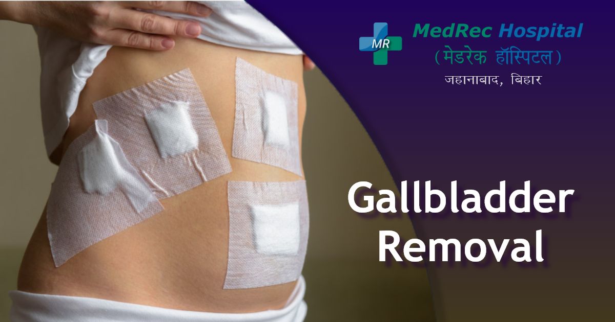 gallbladder removal surgery