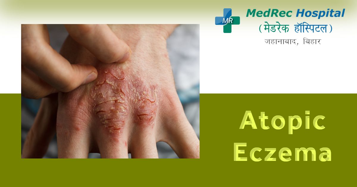 Atopic Dermatitis Causes