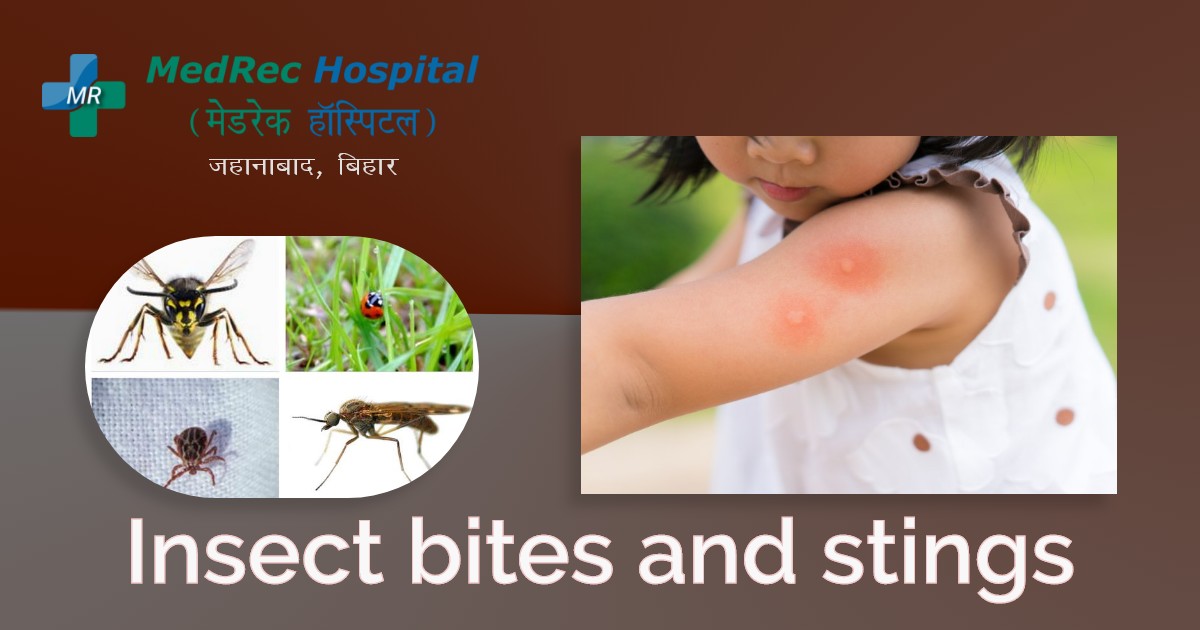 insect bites and stings