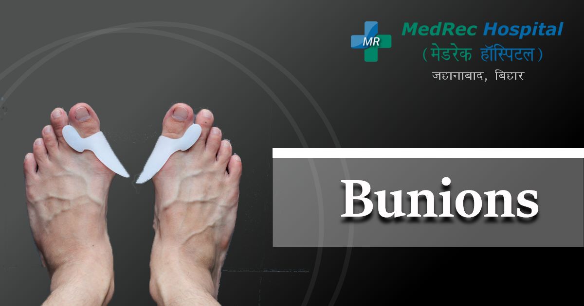 bunions