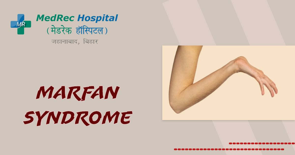 Marfan Syndrome: Condition that impacts connective tissue