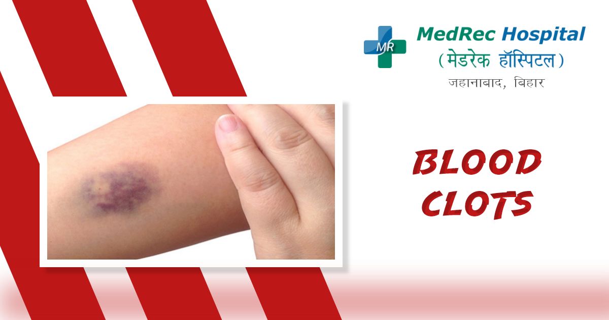 blood clots