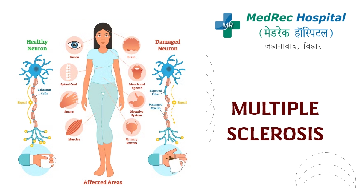 multiple sclerosis