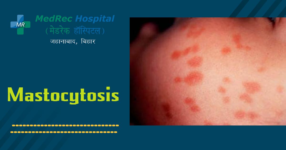 mastocytosis