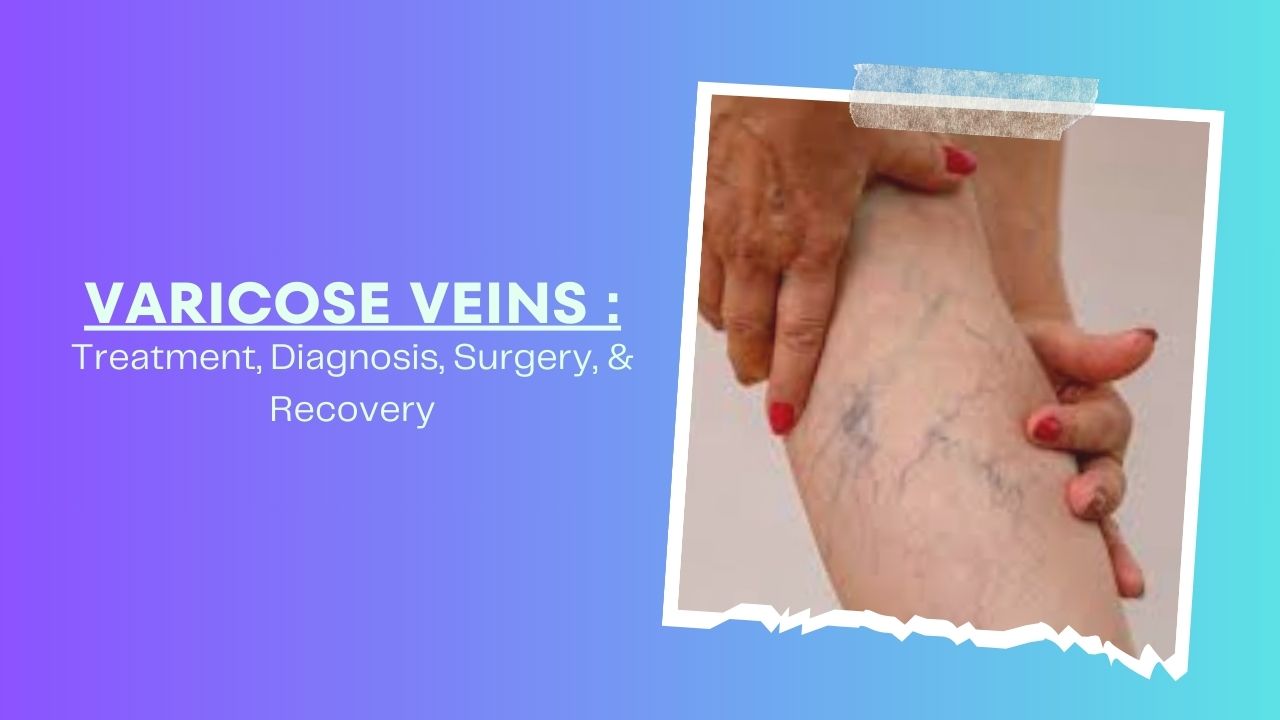 Varicose Veins - Treatment, Diagnosis, Surgery, & Recovery