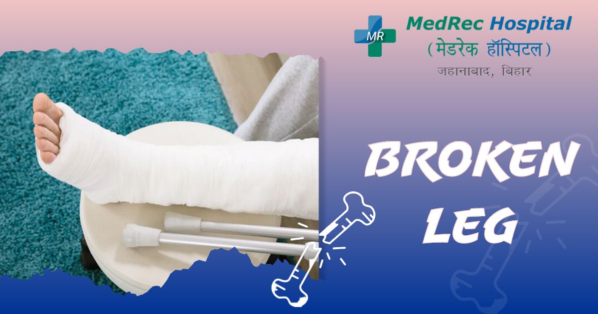 broken leg