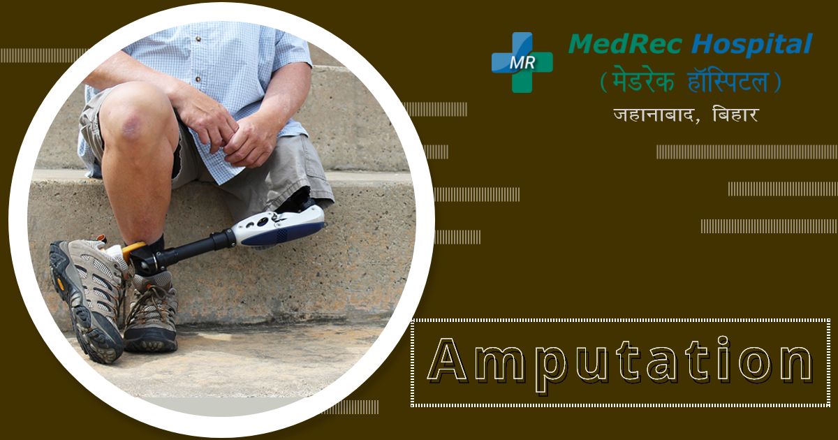 amputations