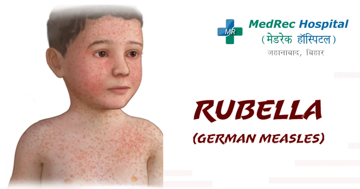 rubella symptoms