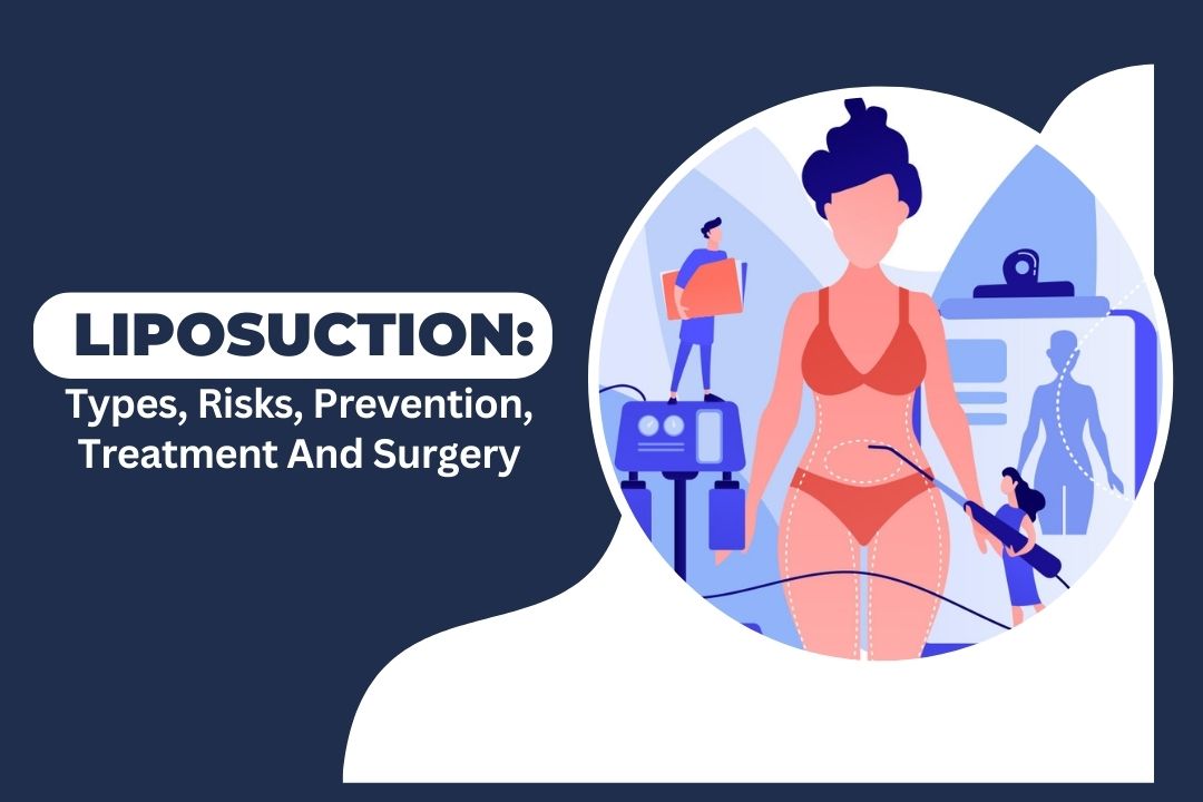 Liposuction Types, Risks, Prevention, Treatment And Surgery