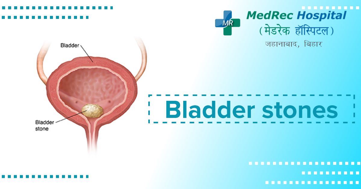 bladder stone