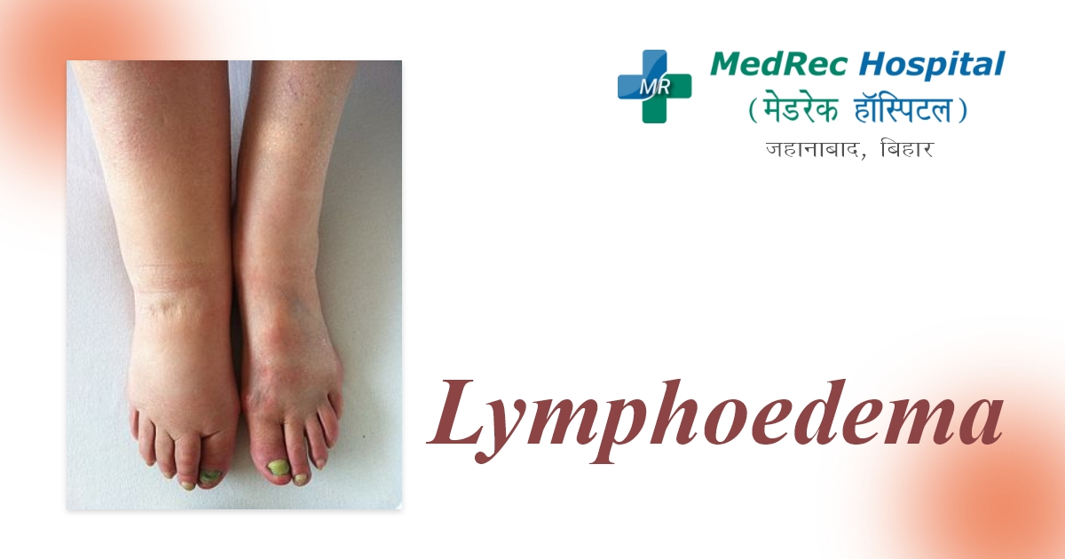 lymphedema