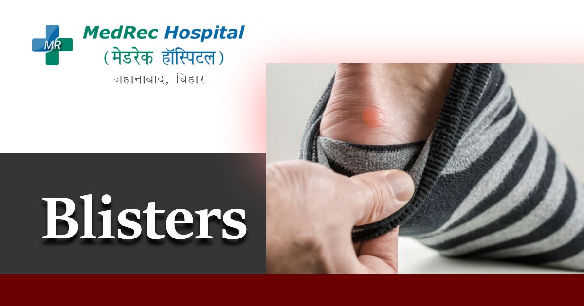 blisters