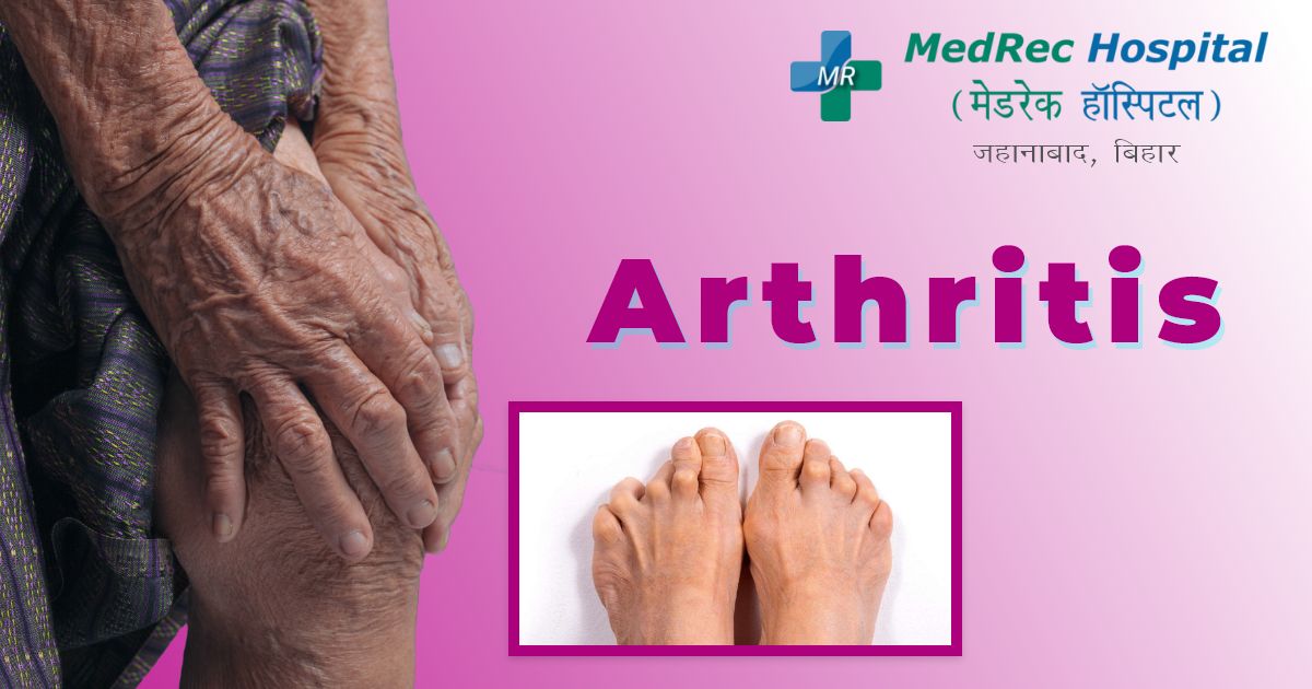 arthritis