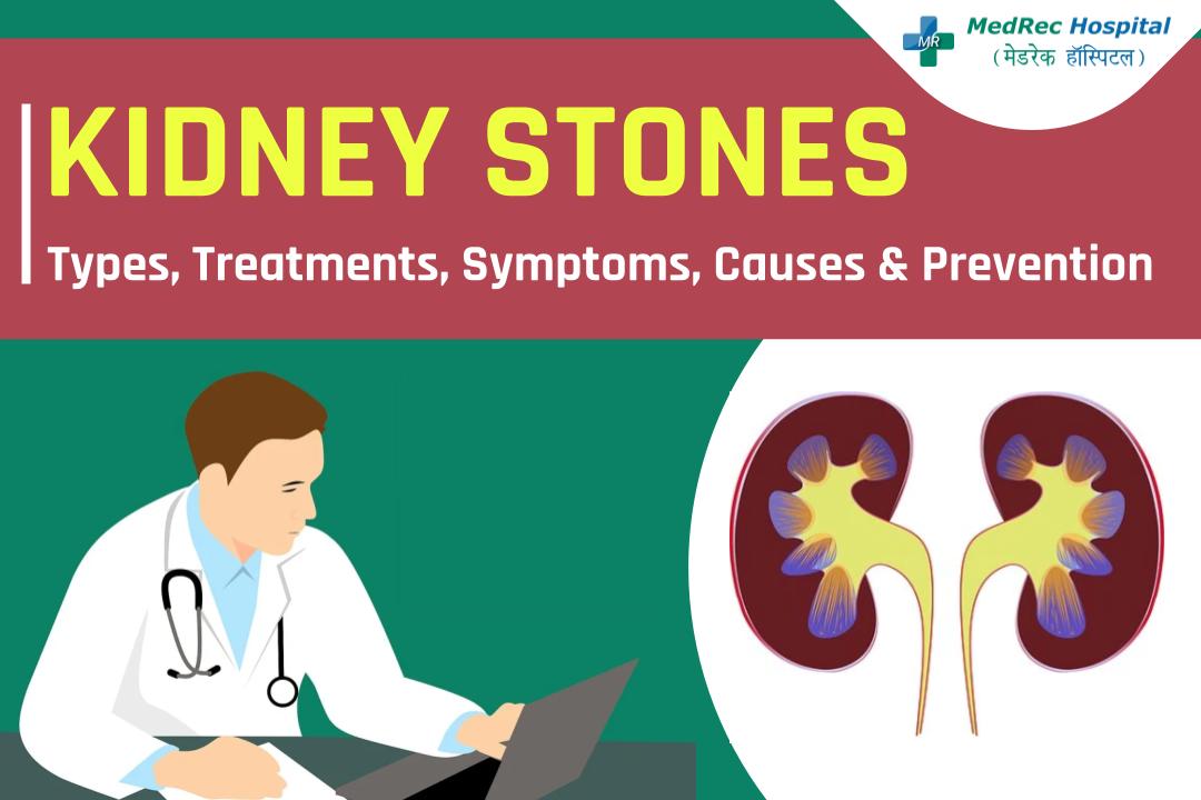 Kidney Stones Explained Types, Treatments, Symptoms, Causes Photo