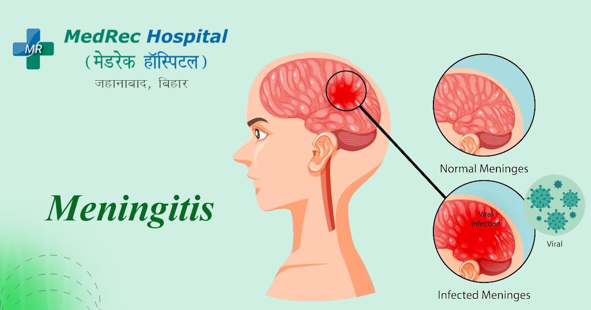 meningitis diagnosis