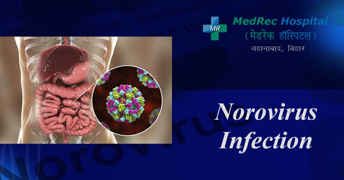norovirus infection